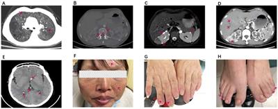 A case report and review of rheumatoid arthritis co-occurring with tuberous sclerosis complex, a rare occurrence